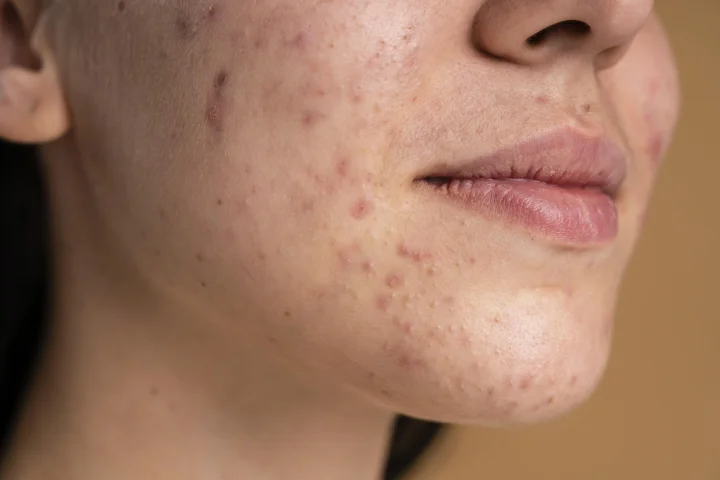 Confident young woman with acne close up