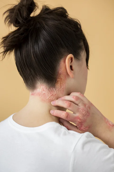 Psoriasis eczema neck patient